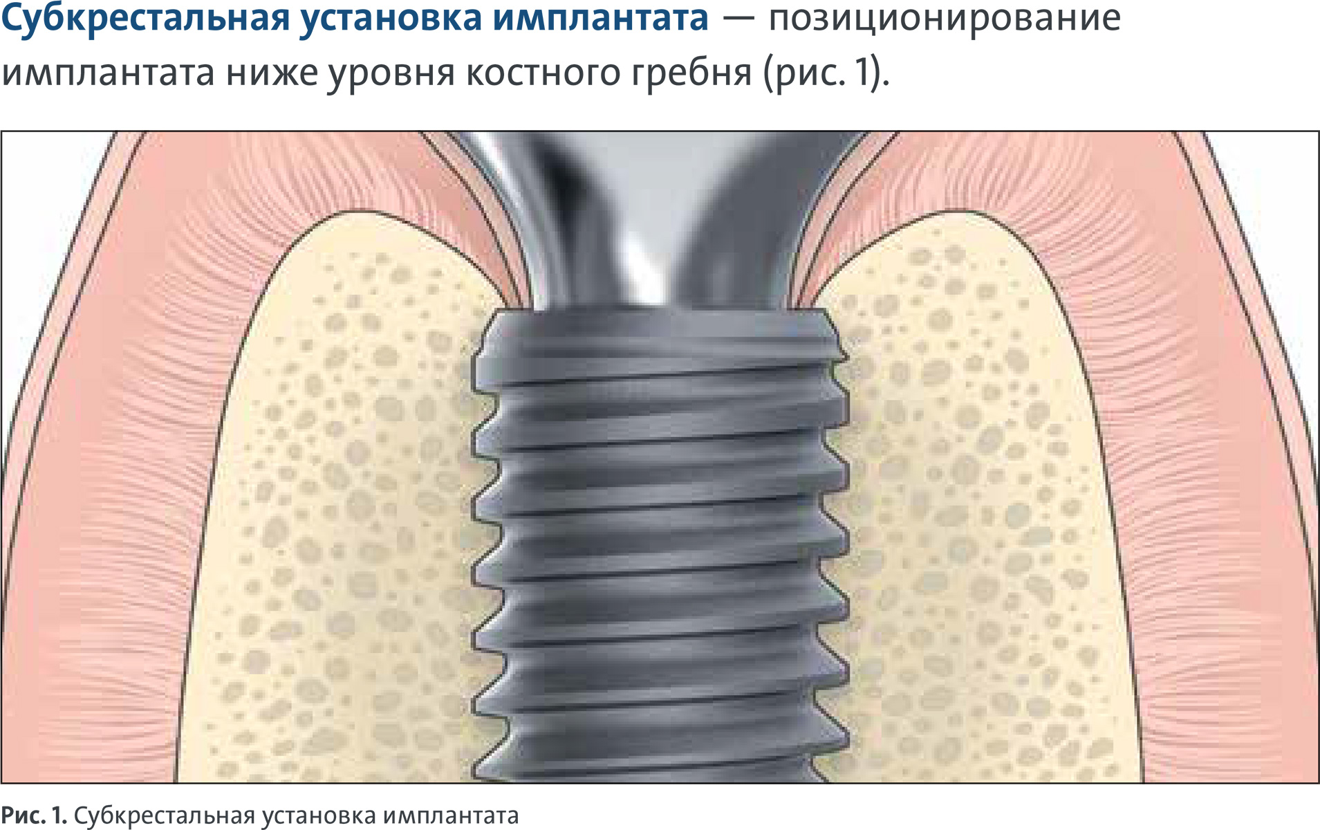 Субкрестальная имплантация в Орле