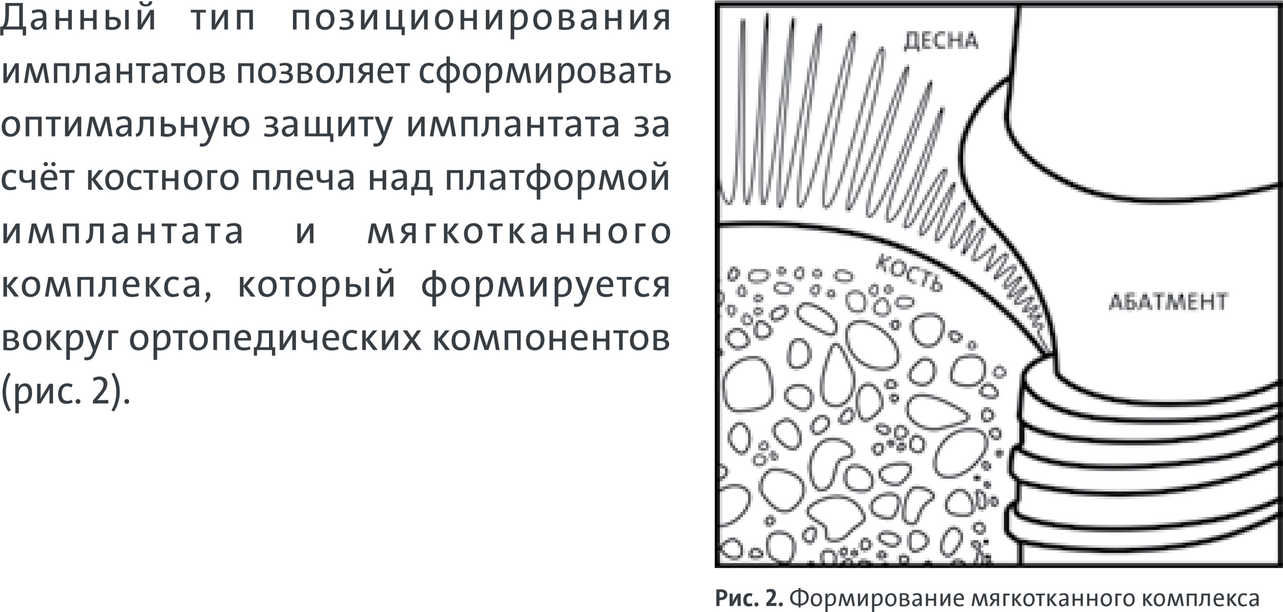 Субкрестальная имплантация в Орле